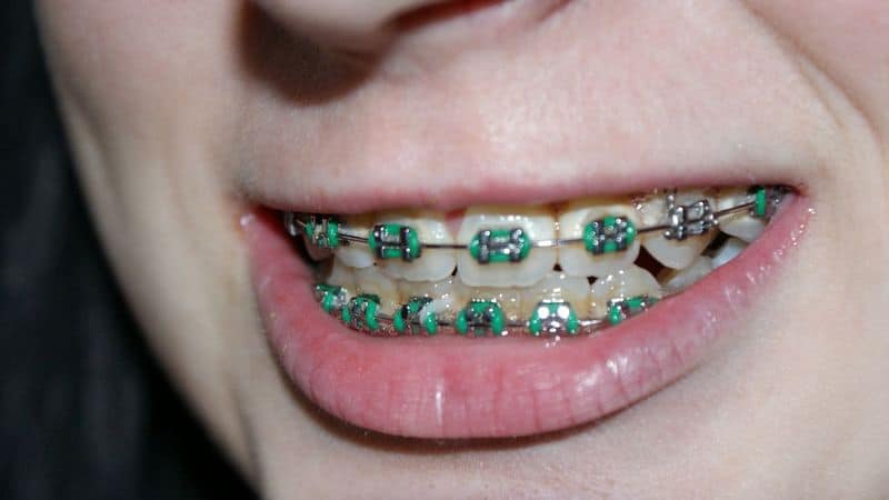 mouth full of braces